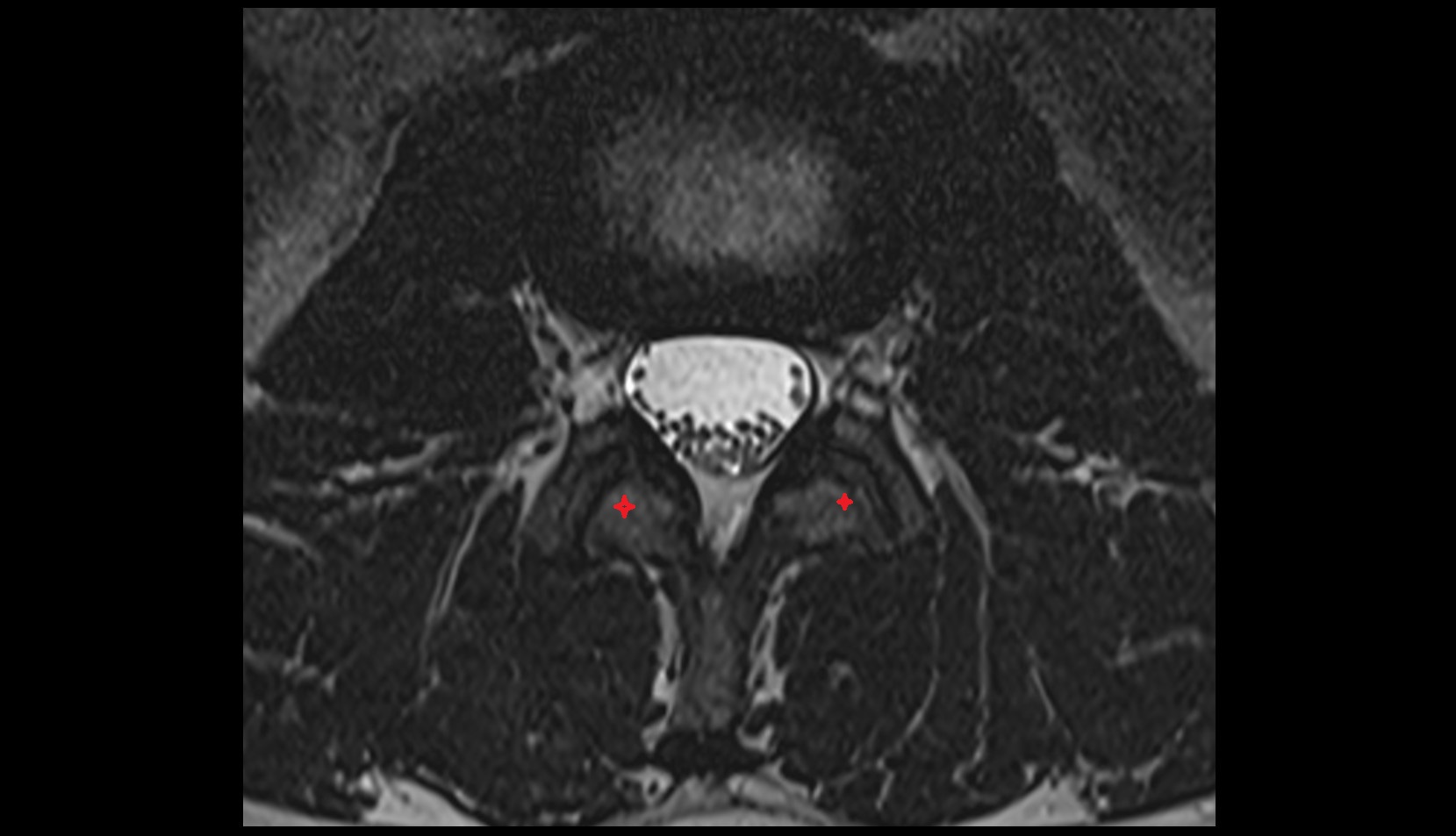 Inferior articular process axial mri image