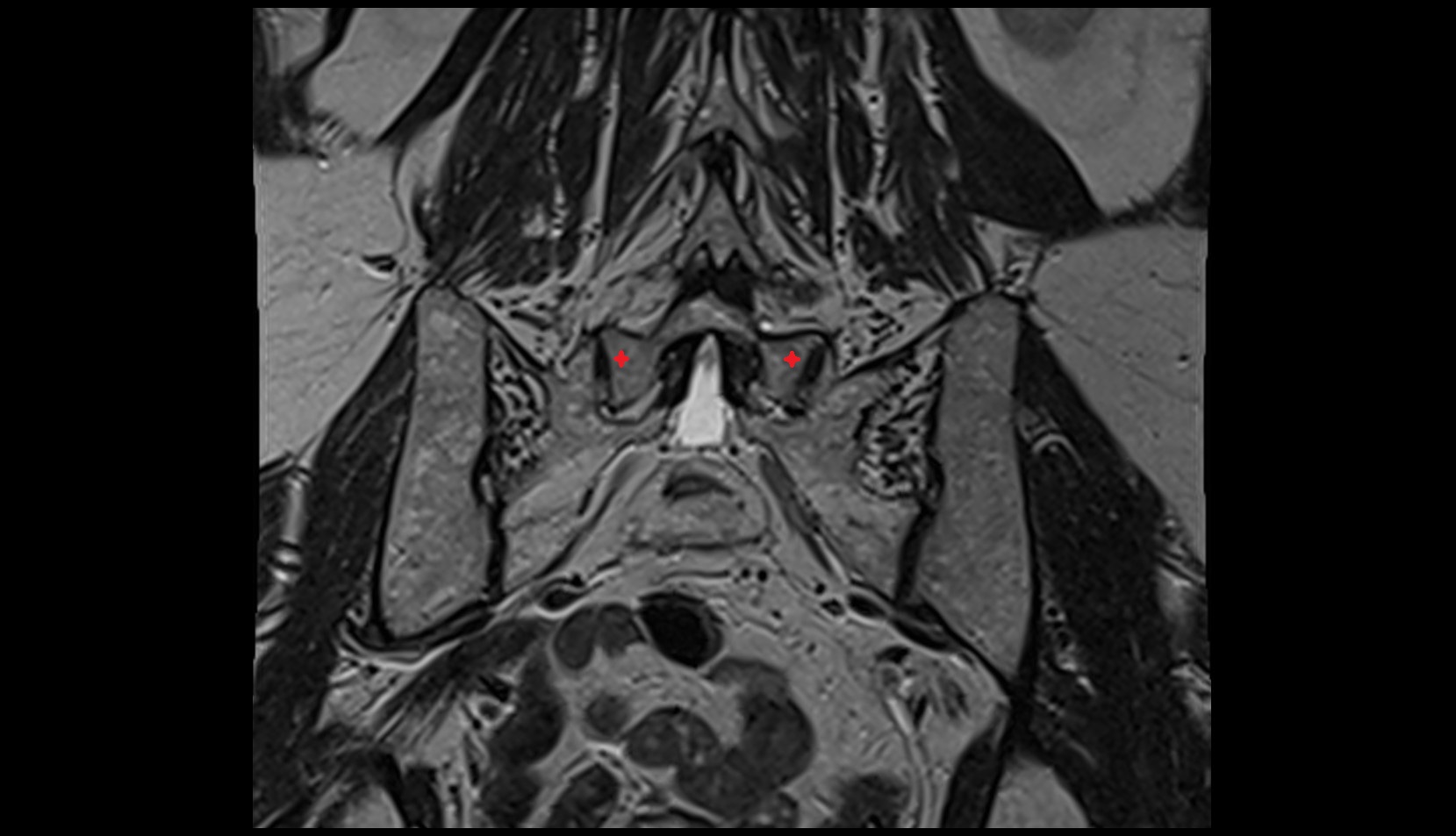 Inferior articular process of L5 vertebra mri coronal image
