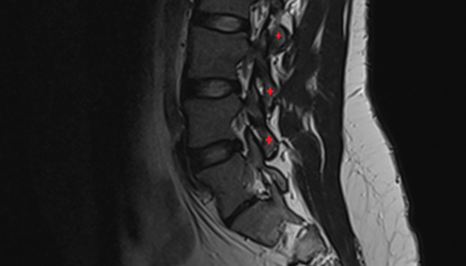 Inferior articular process of vertebra  mri sag  image -img-00000-00000