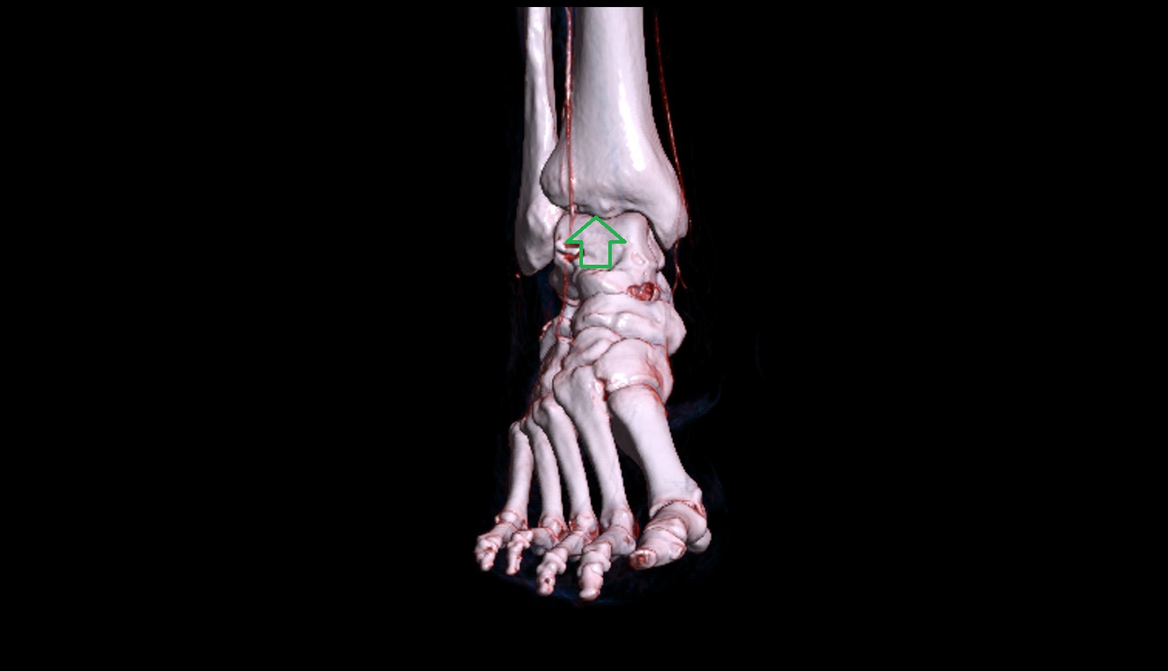Inferior articular surface of the tibia