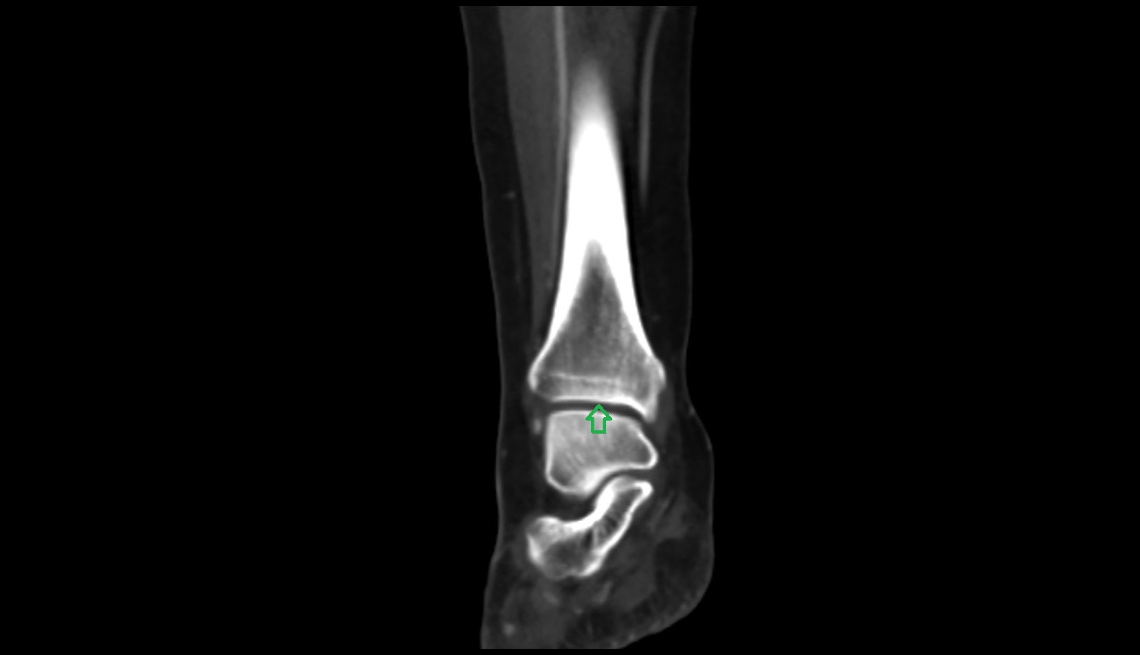 Inferior articular surface of the tibia ct coronal