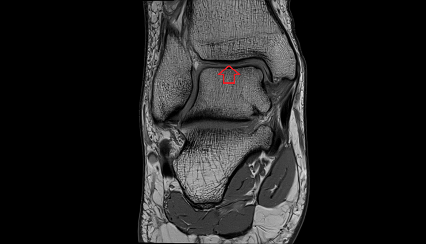 Inferior articular surface of the tibia mri  anatomy labelled image-img-00000-00000