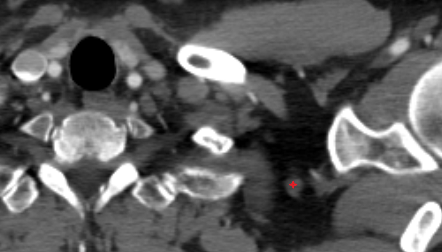 Inferior belly of omohyoid muscle  anatomy CT axial  image -img-00000-00000