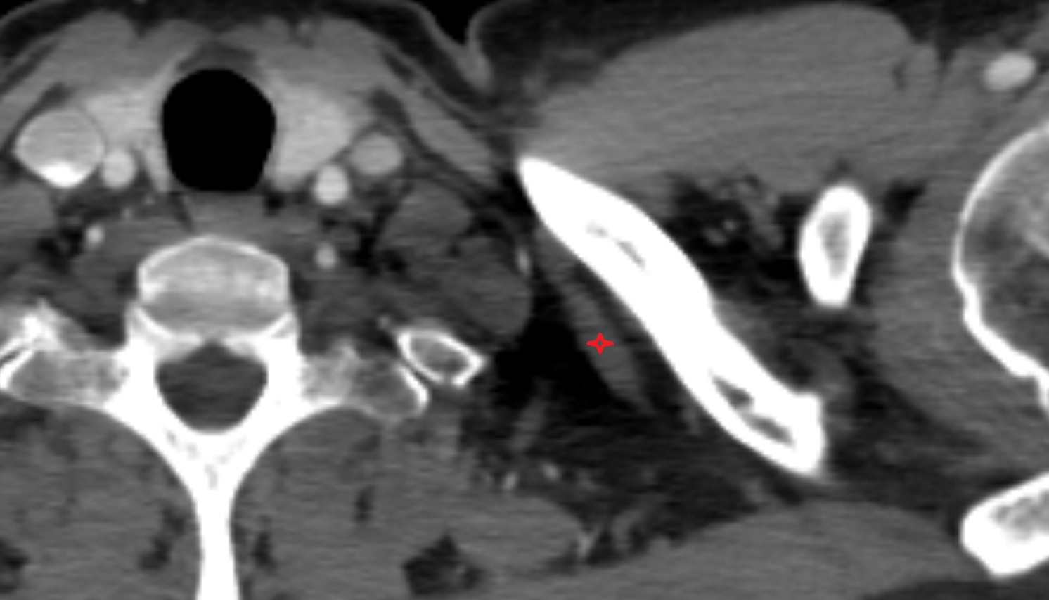 Inferior belly of omohyoid muscle  anatomy CT axial  image -img-00000-00000_00001