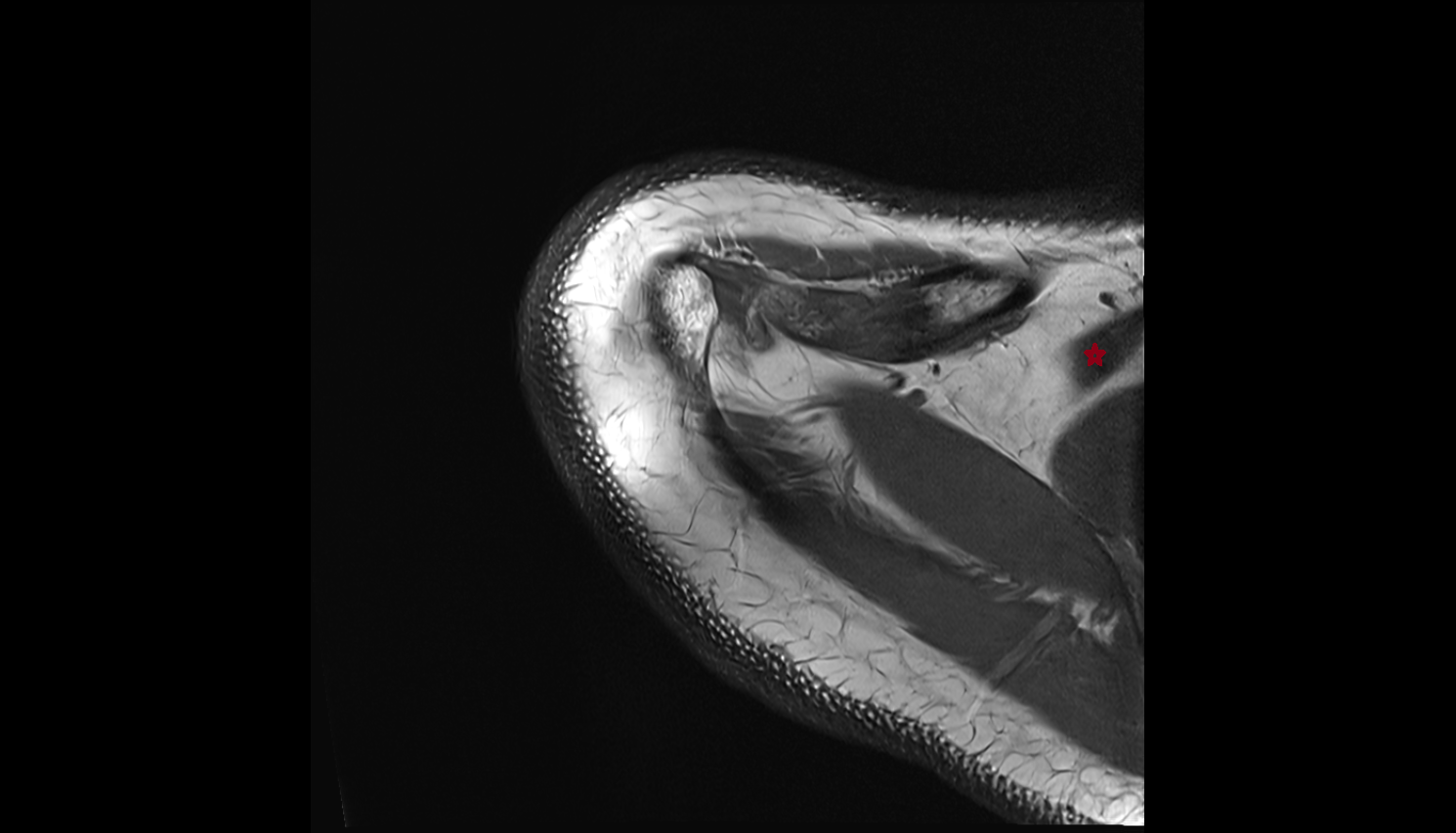 Inferior belly of omohyoid muscle  axial cross sectional anatomy 3T MRI AI enhanced radiology image-img-00000-00000