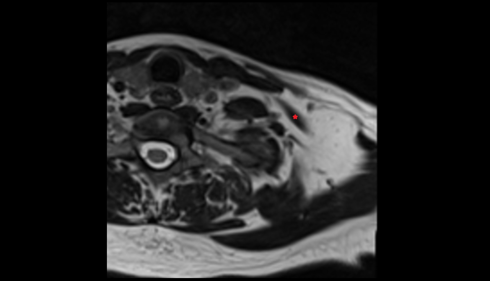 Inferior belly of omohyoid muscle mri axial image