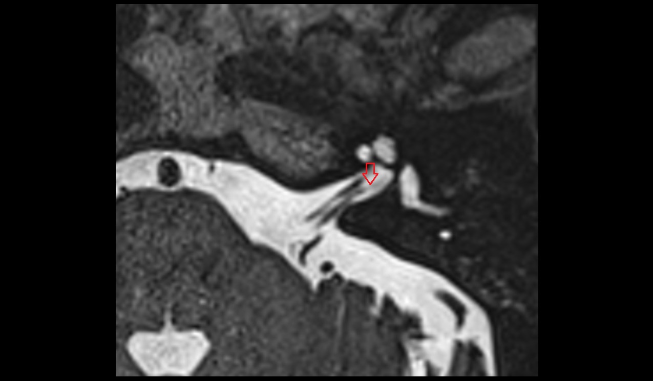 Inferior branch of vestibular nerve MRI 3T axial image