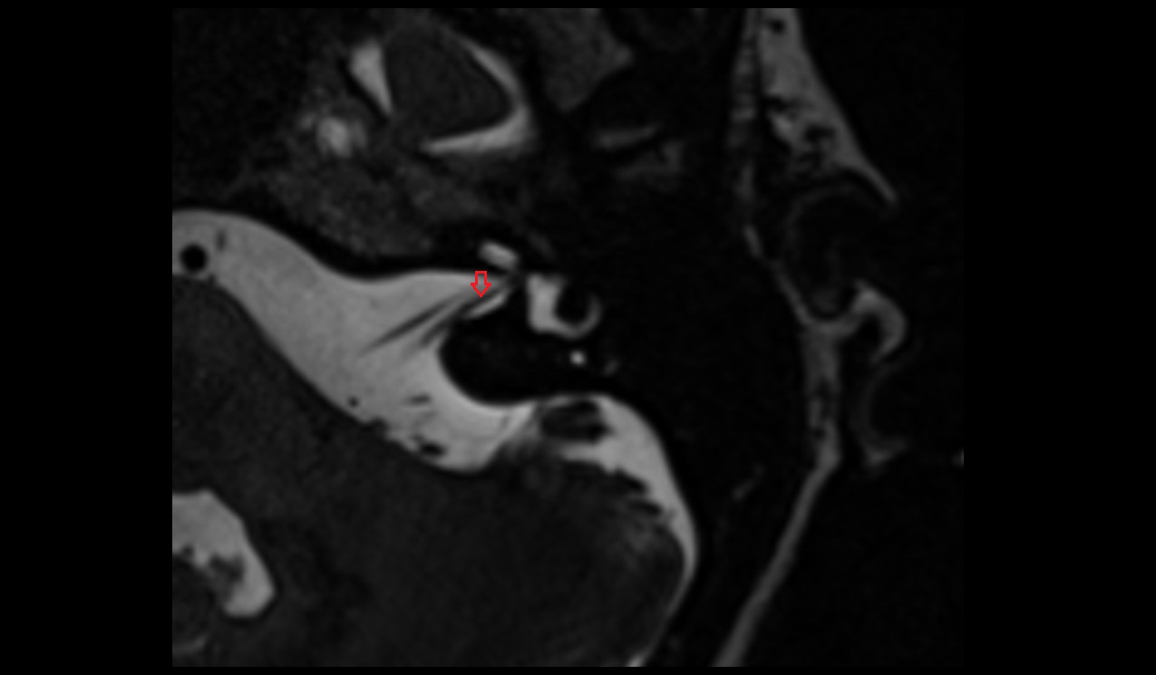 Inferior branch of vestibular nerve MRI 3T axial image 1
