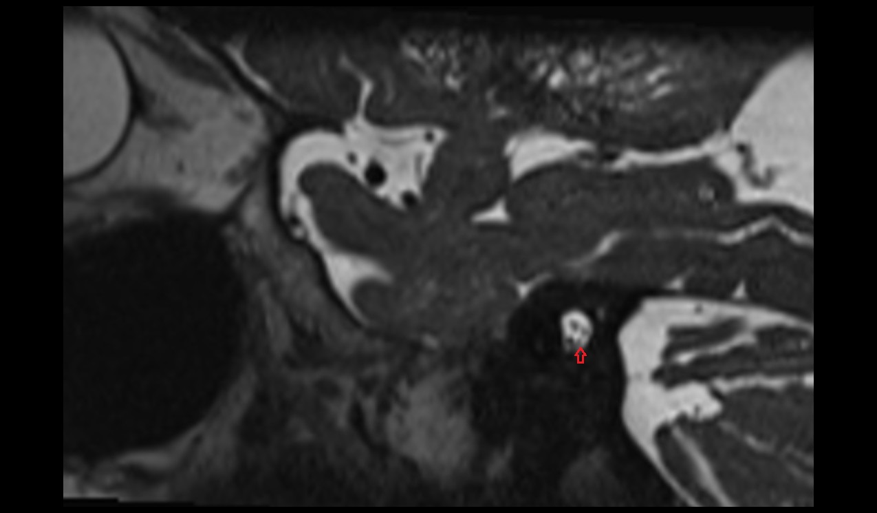 Inferior branch of vestibular nerve MRI 3T sagittal image