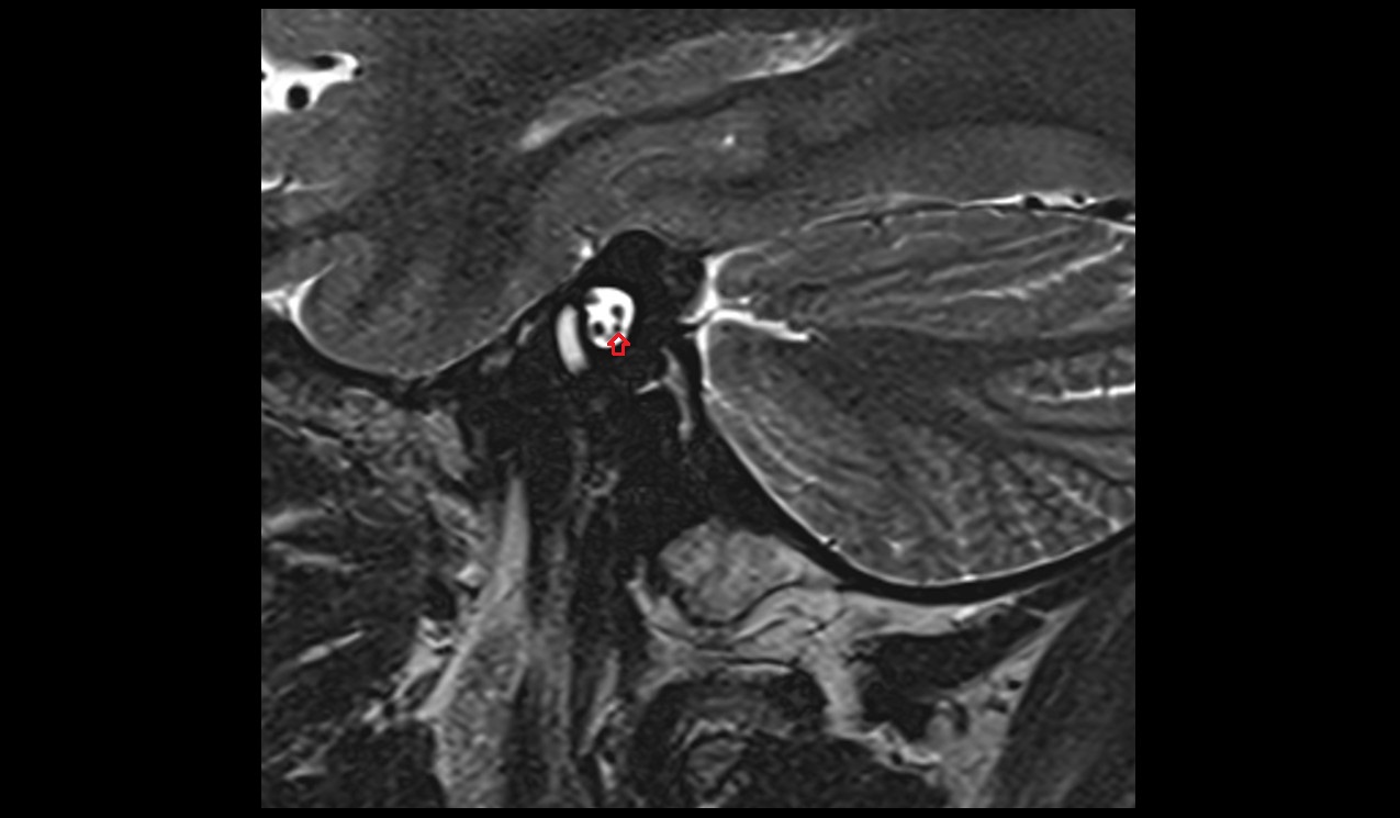 Inferior branch of vestibular nerve MRI 3T sagittal image 1