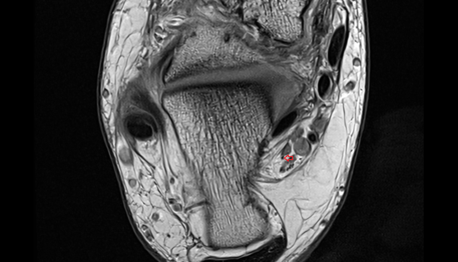 Inferior calcaneal nerve (Baxter’s nerve) axial cross sectional anatomy 3T MRI AI enhanced radiology image-img-00000-00000