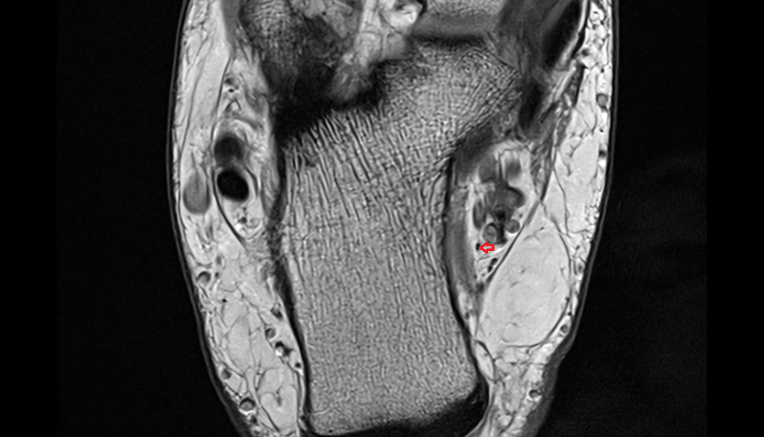 Inferior calcaneal nerve (Baxter’s nerve) axial cross sectional anatomy 3T MRI AI enhanced radiology image-img-00000-00000_00001
