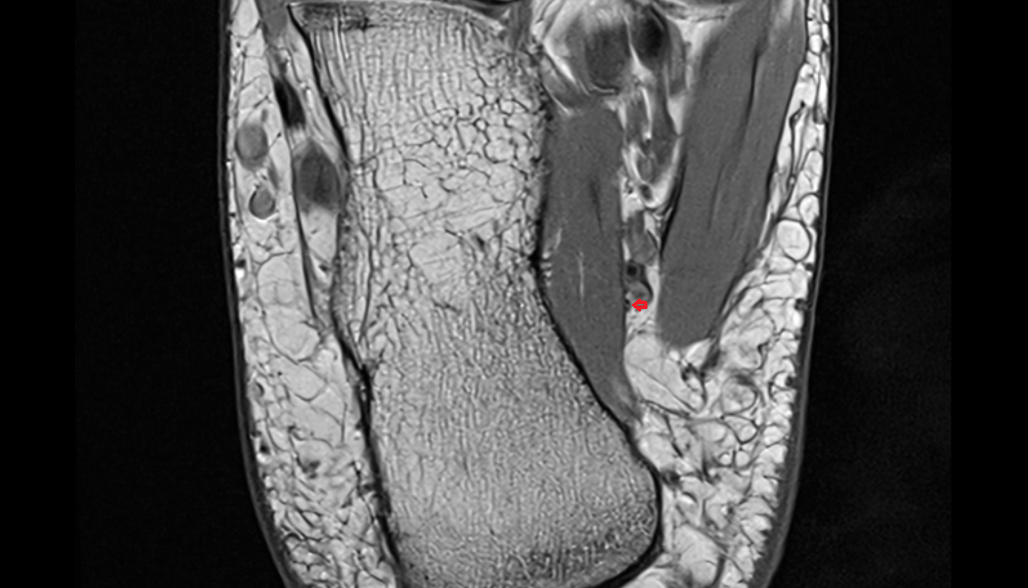 Inferior calcaneal nerve (Baxter’s nerve) axial cross sectional anatomy 3T MRI AI enhanced radiology image-img-00000-00000_00002