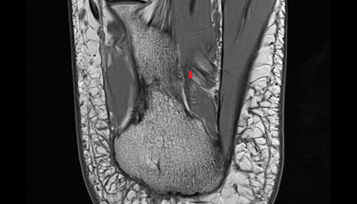 Inferior calcaneal nerve (Baxter’s nerve) axial cross sectional anatomy 3T MRI AI enhanced radiology image-img-00000-00000_00003