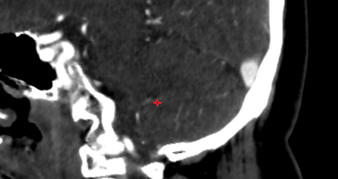 Inferior cerebellar peduncle  CT sag  anatomy image -img-00001-00001_00001