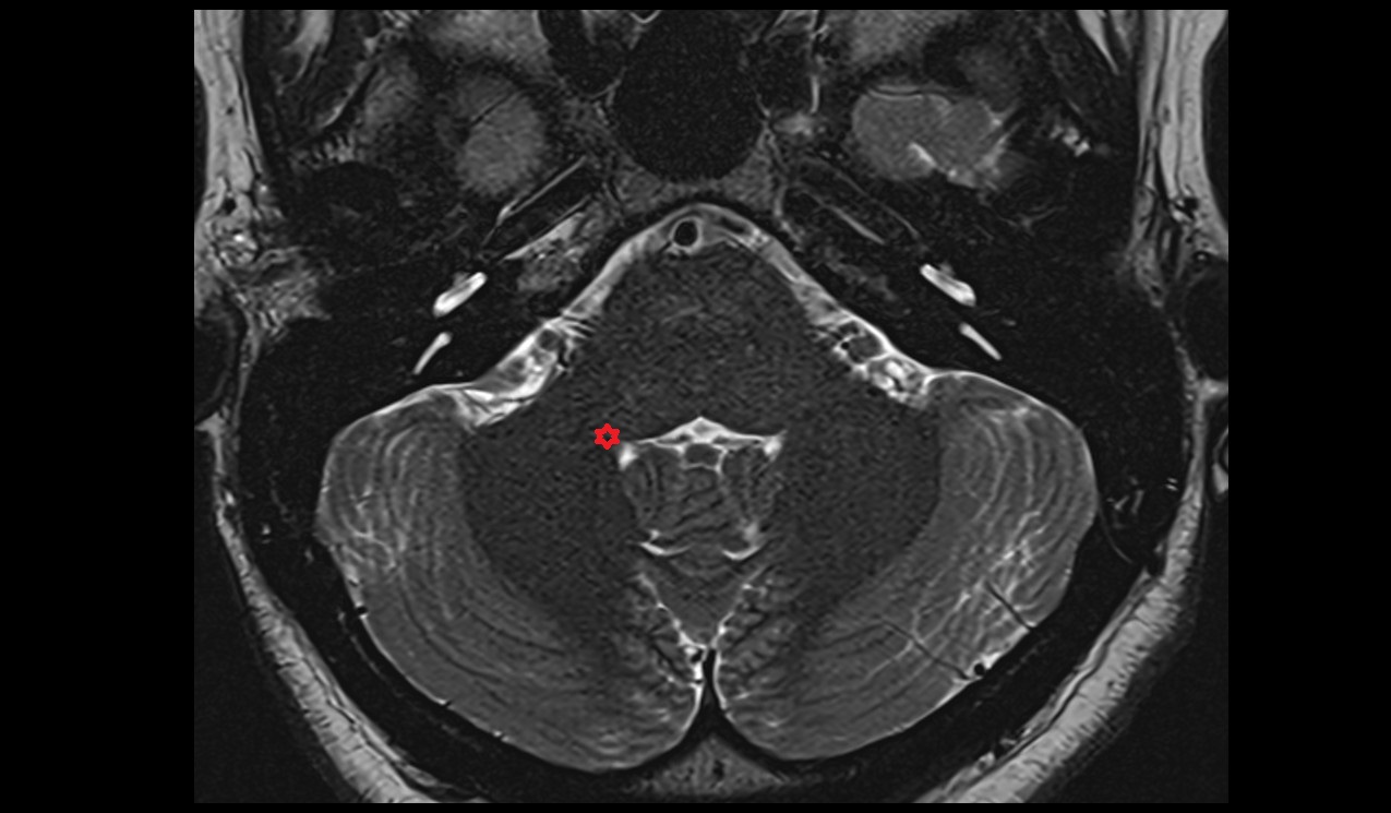 Inferior cerebellar peduncle MRI 3T axial image