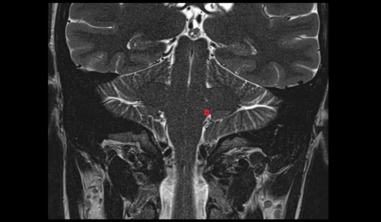 Inferior cerebellar peduncle MRI 3Tcoronal image