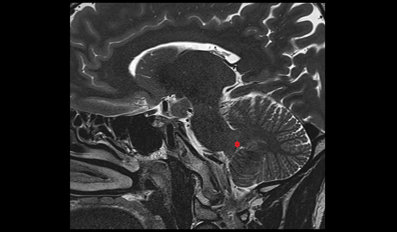 Inferior cerebellar peduncle MRI 3T sagittal image