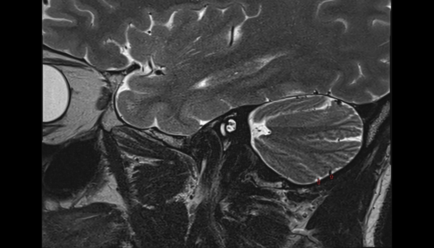 Inferior cerebellar veins  mri sag  image -img-00000-00000