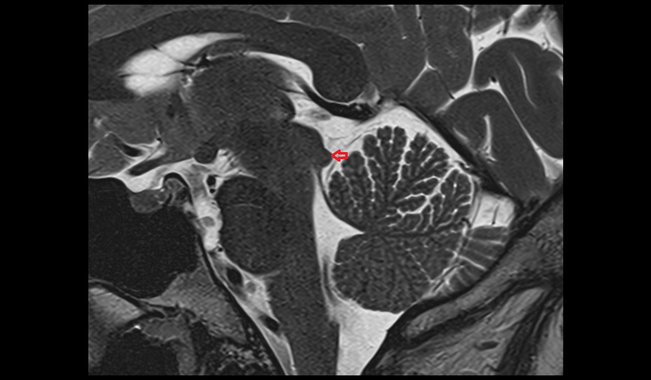 Inferior colliculus mri 3t sagittal image