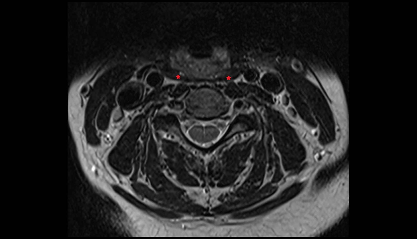 Inferior constrictor muscle of pharynx