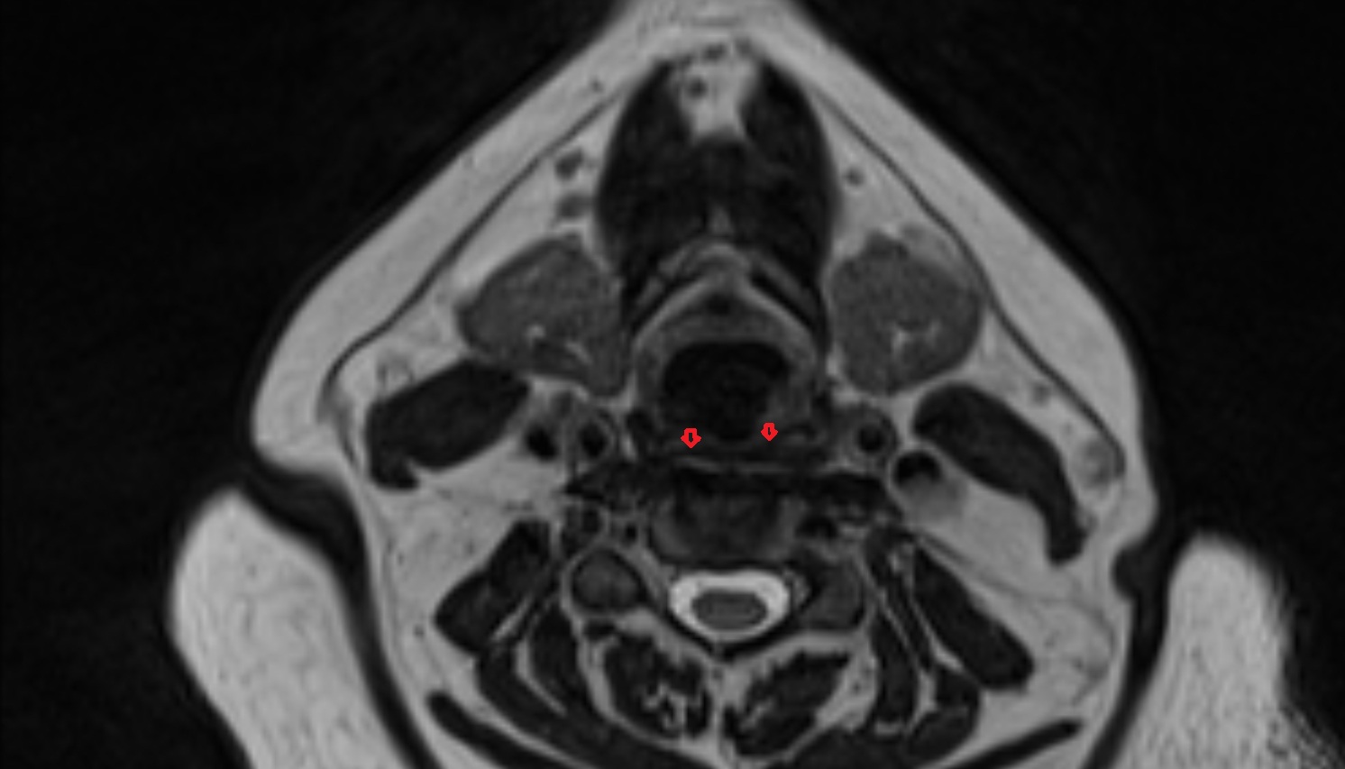 Inferior constrictor muscle of pharynx mri axial  image -img-00000-00000