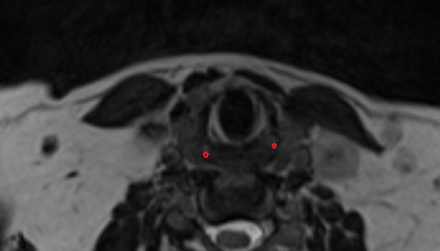 Inferior cornu of thyroid cartilage  mri axial  image -img-00000-00000