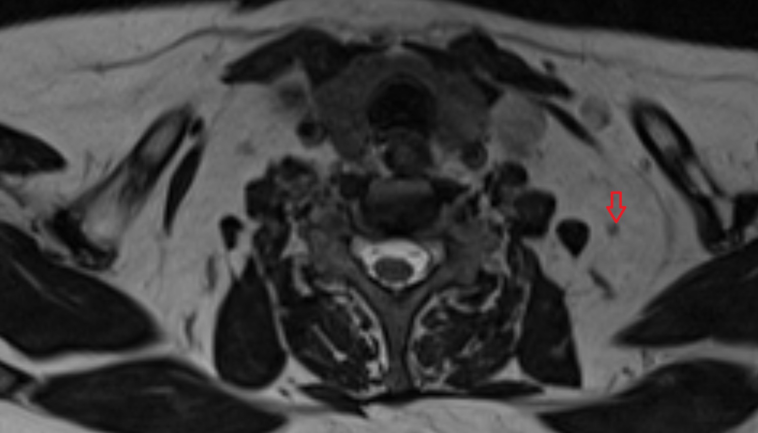 Inferior deep cervical lymph nodes  mri axial  image -img-00000-00000