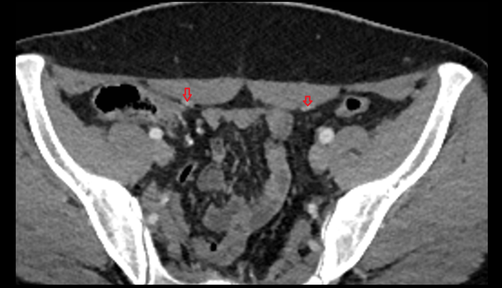 Inferior epigastric artery ct axial image 0