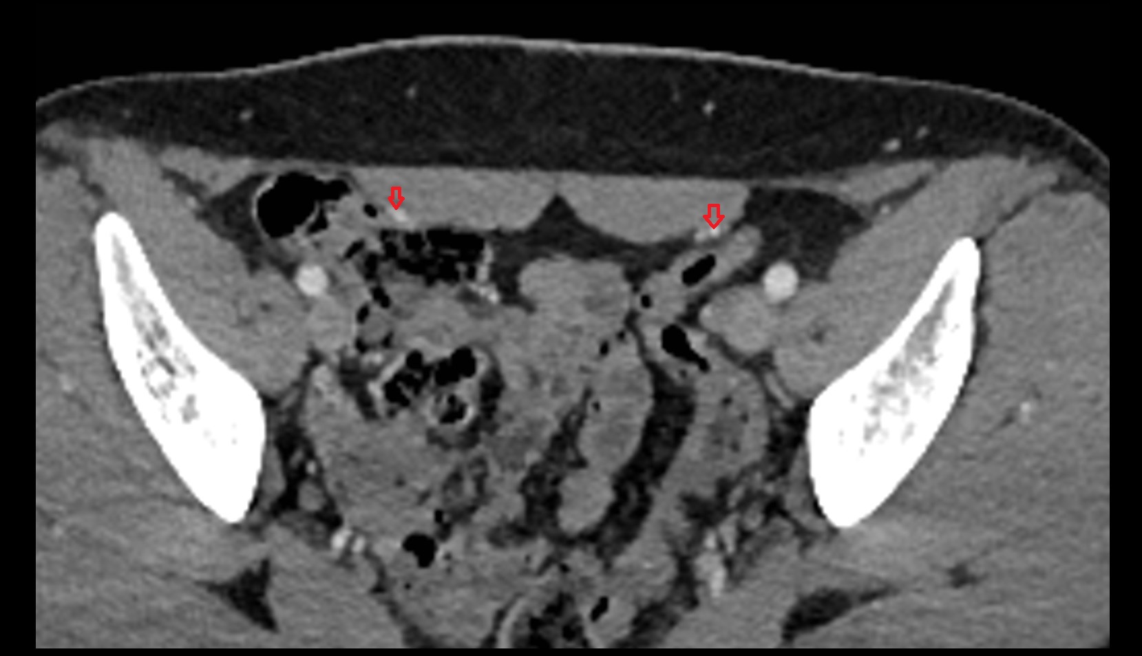 Inferior epigastric artery ct axial image 1