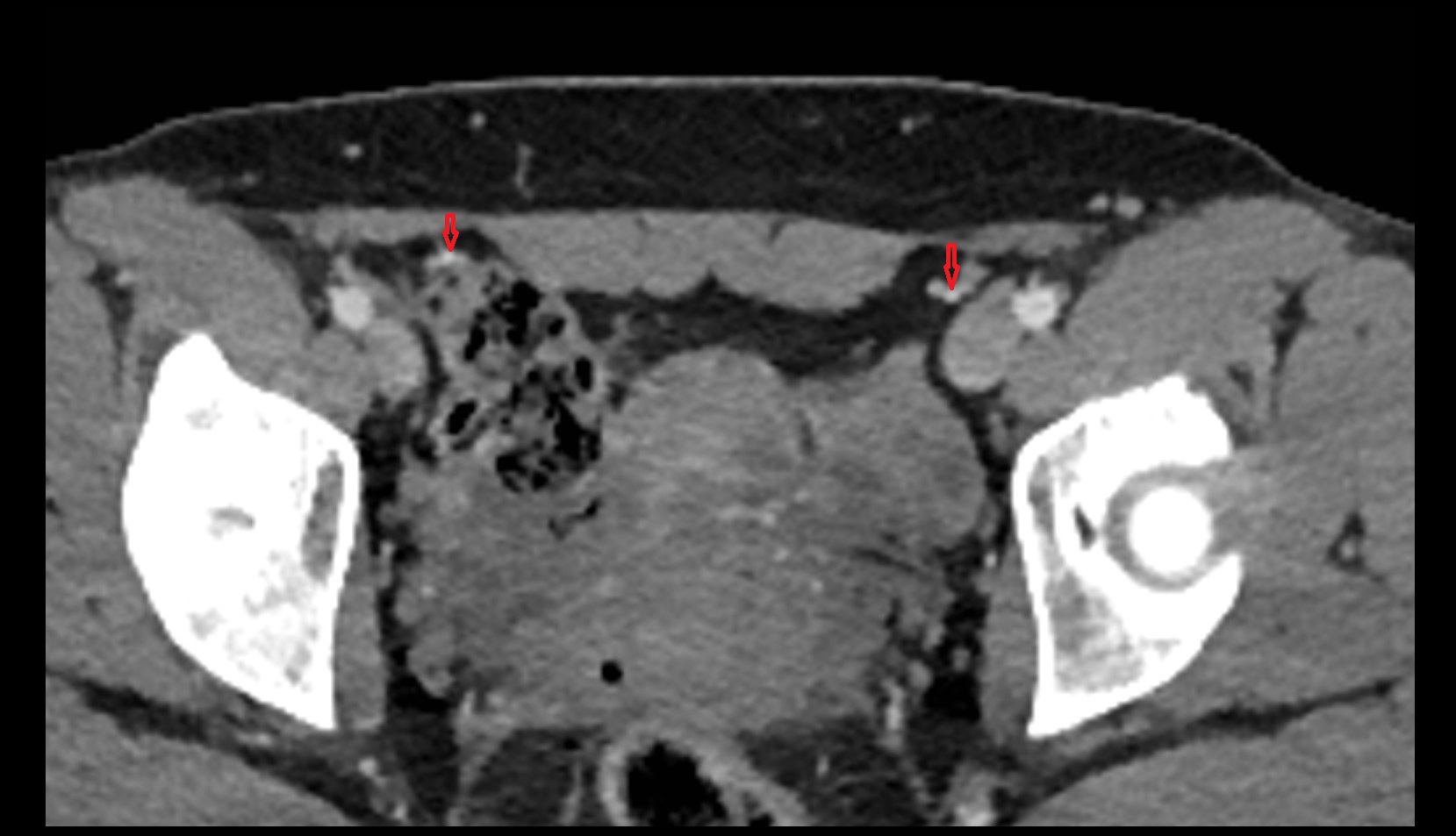 Inferior epigastric artery ct axial image 2