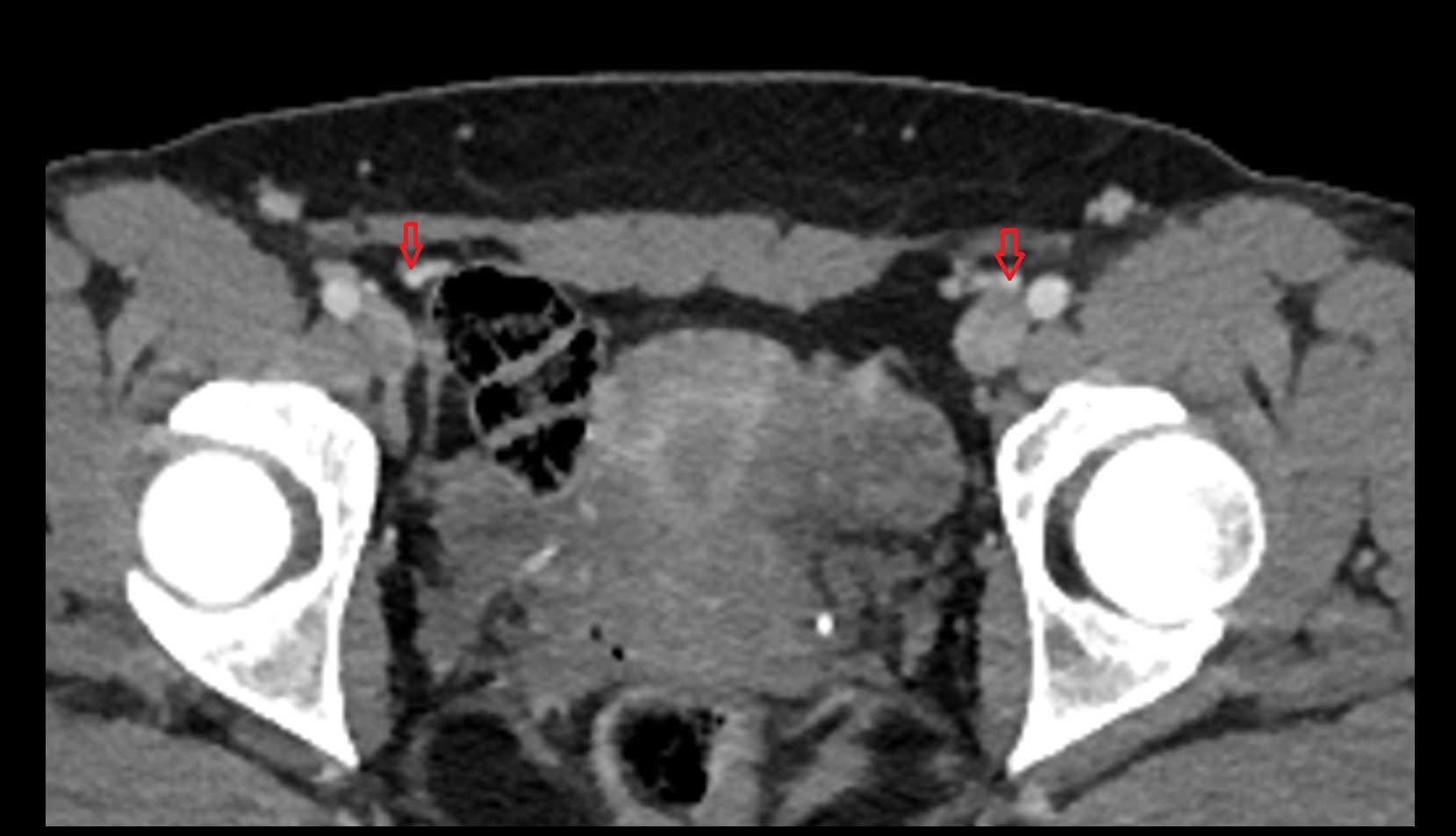 Inferior epigastric artery ct axial image 3