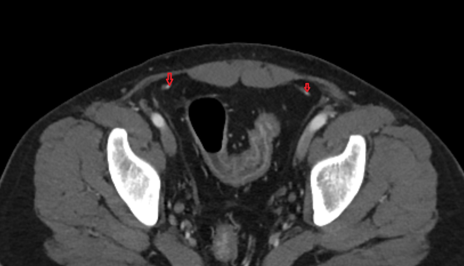 Inferior epigastric artery ct axial image   CT axial anatomy  image-img-00000-00000