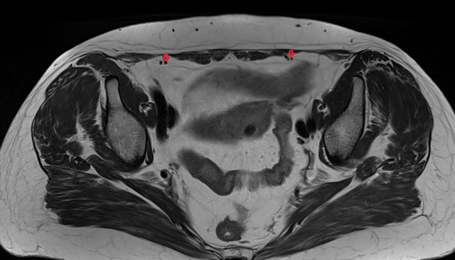 Inferior epigastric artery mri axial  image   CT axial anatomy  image-img-00000-00000