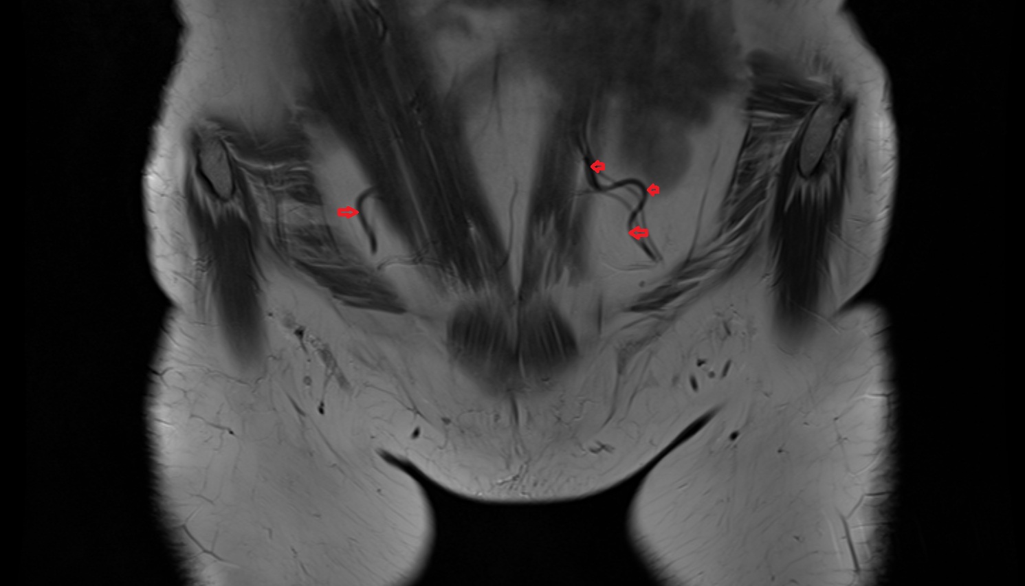 Inferior epigastric artery mri coronal  image   CT axial anatomy  image-img-00000-00000