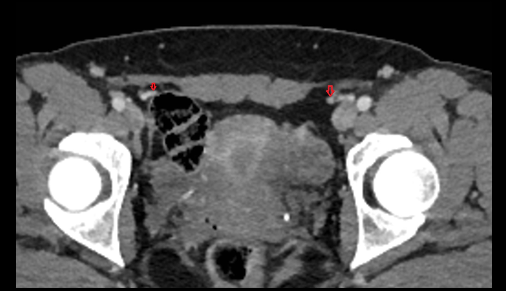 Inferior epigastric vein ct axial image