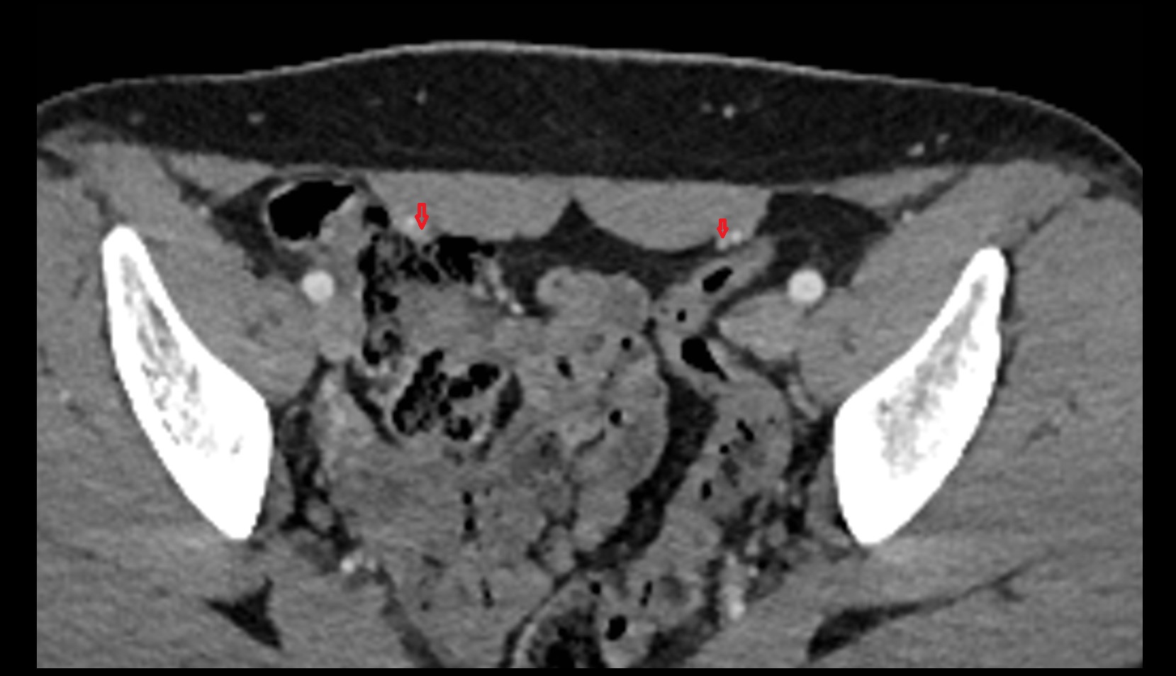 Inferior epigastric vein ct axial image  1