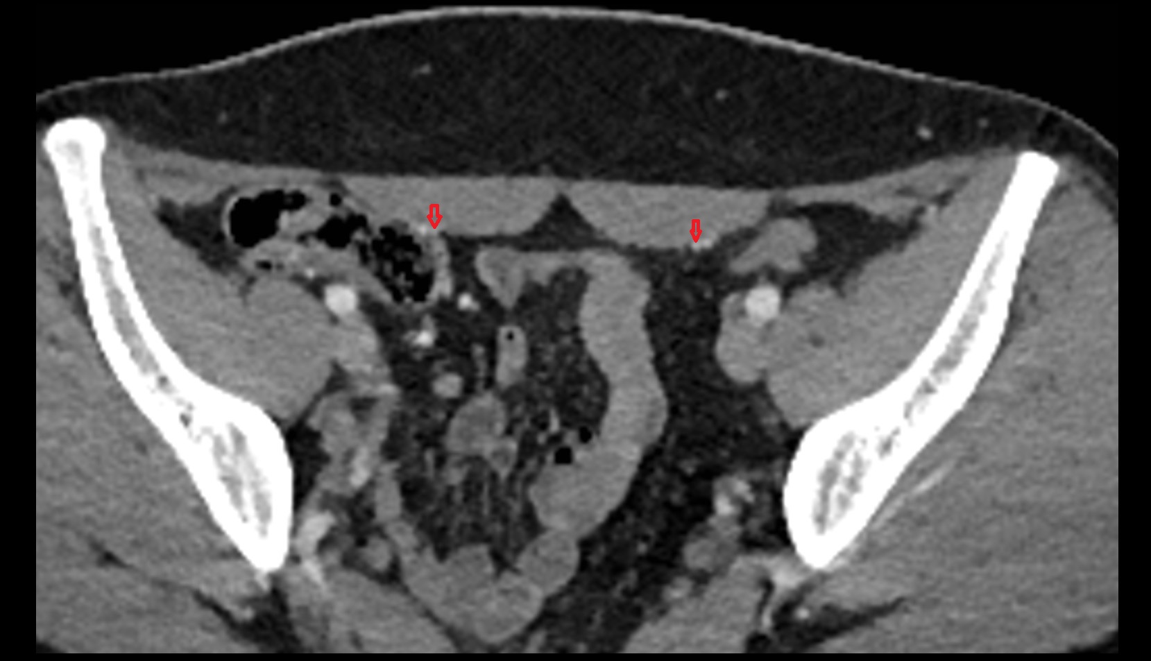 Inferior epigastric vein ct axial image  2