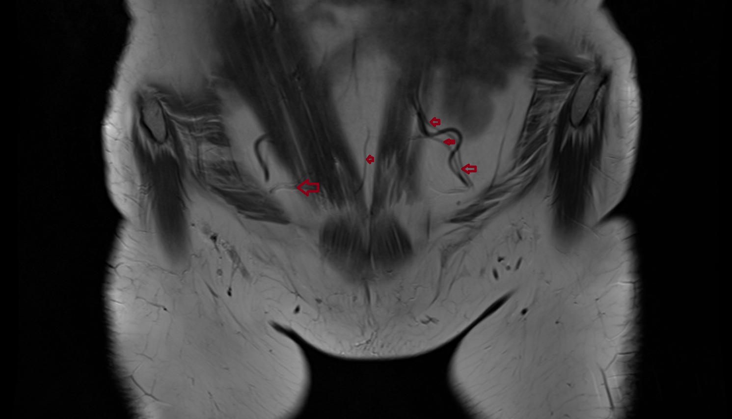 Inferior epigastric veins mri coronal  image   CT axial anatomy  image-img-00000-00000