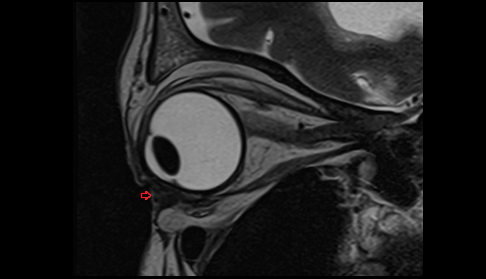 Inferior eyelid mri image