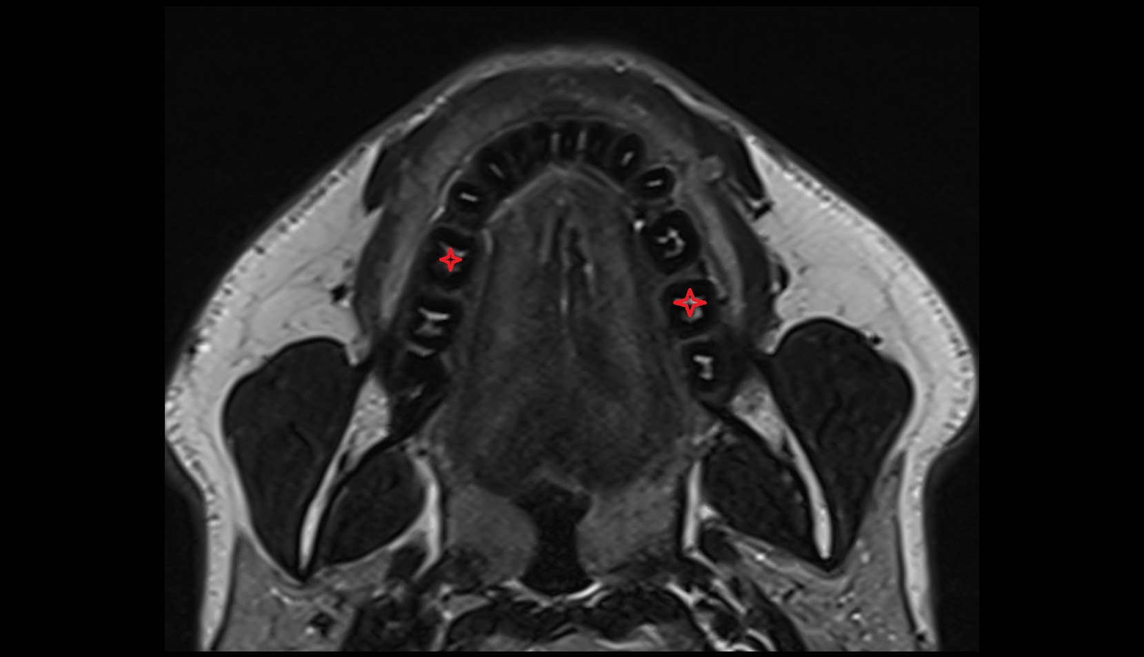 Inferior first molar tooth mri axial image
