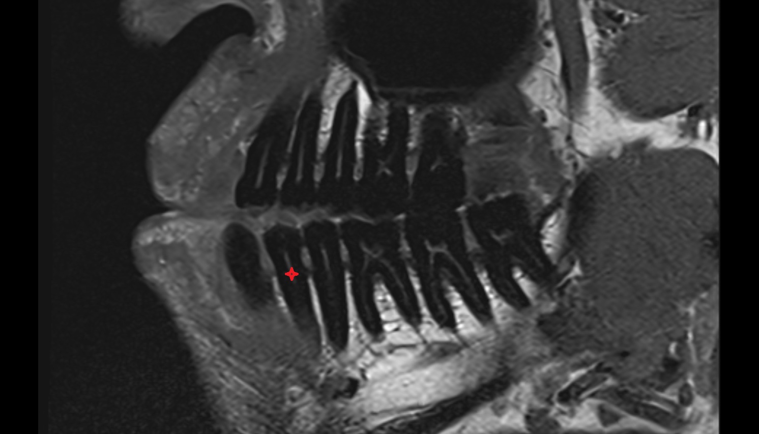 Inferior first premolar tooth mri sag  image -img-00000-00000