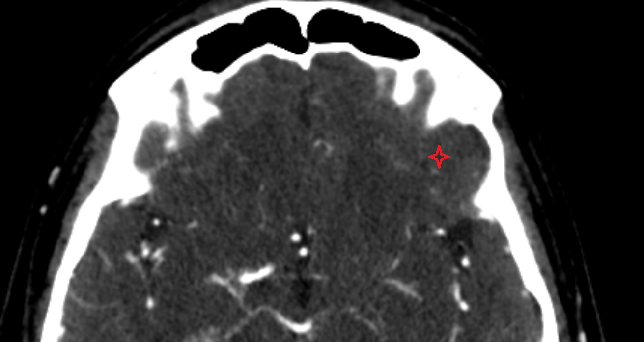 Inferior frontal gyrus  CT sagittal anatomy image -img-00001-00001