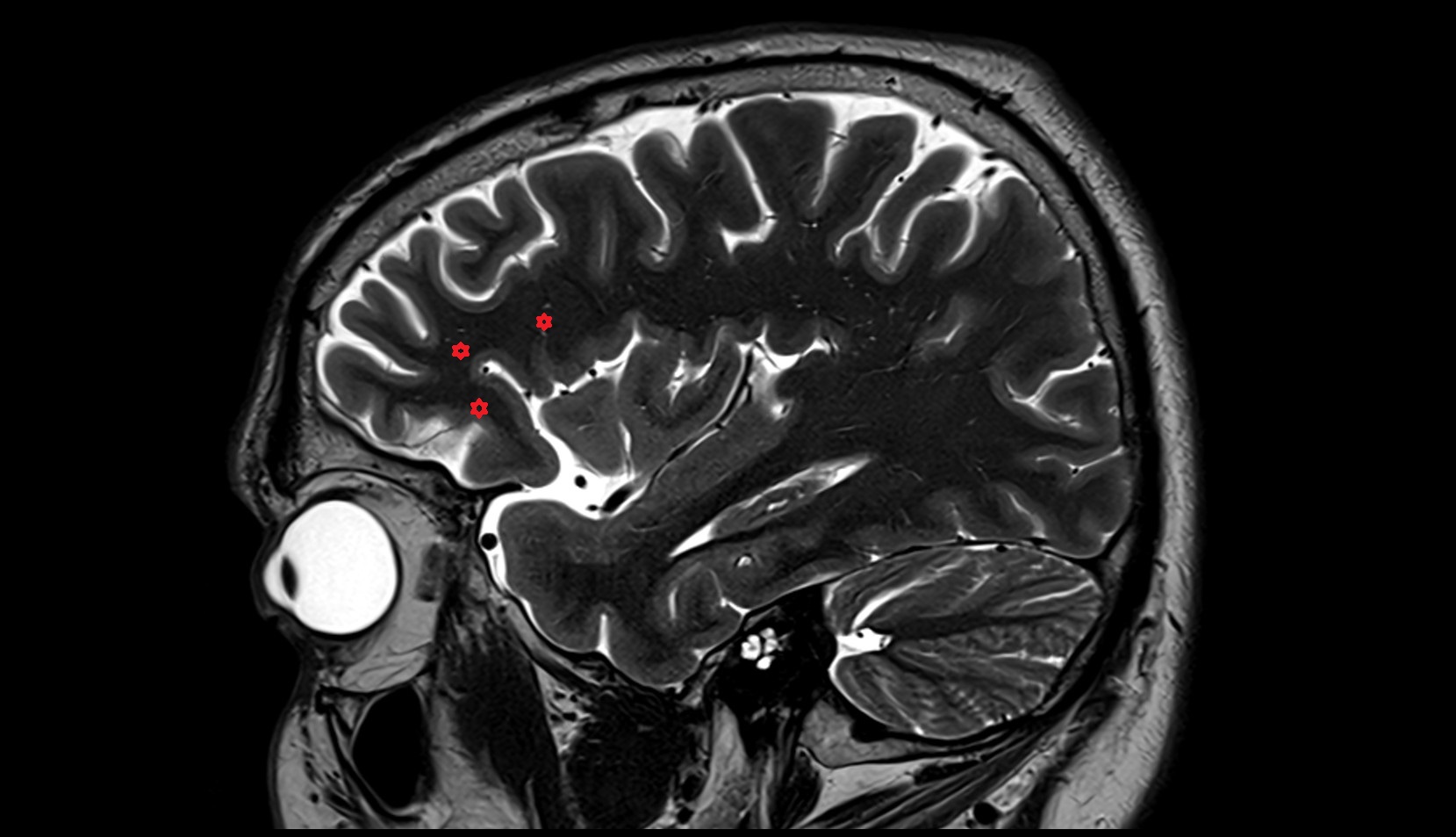 Inferior frontal gyrus MRI 3T SAGITTAL IMAGE