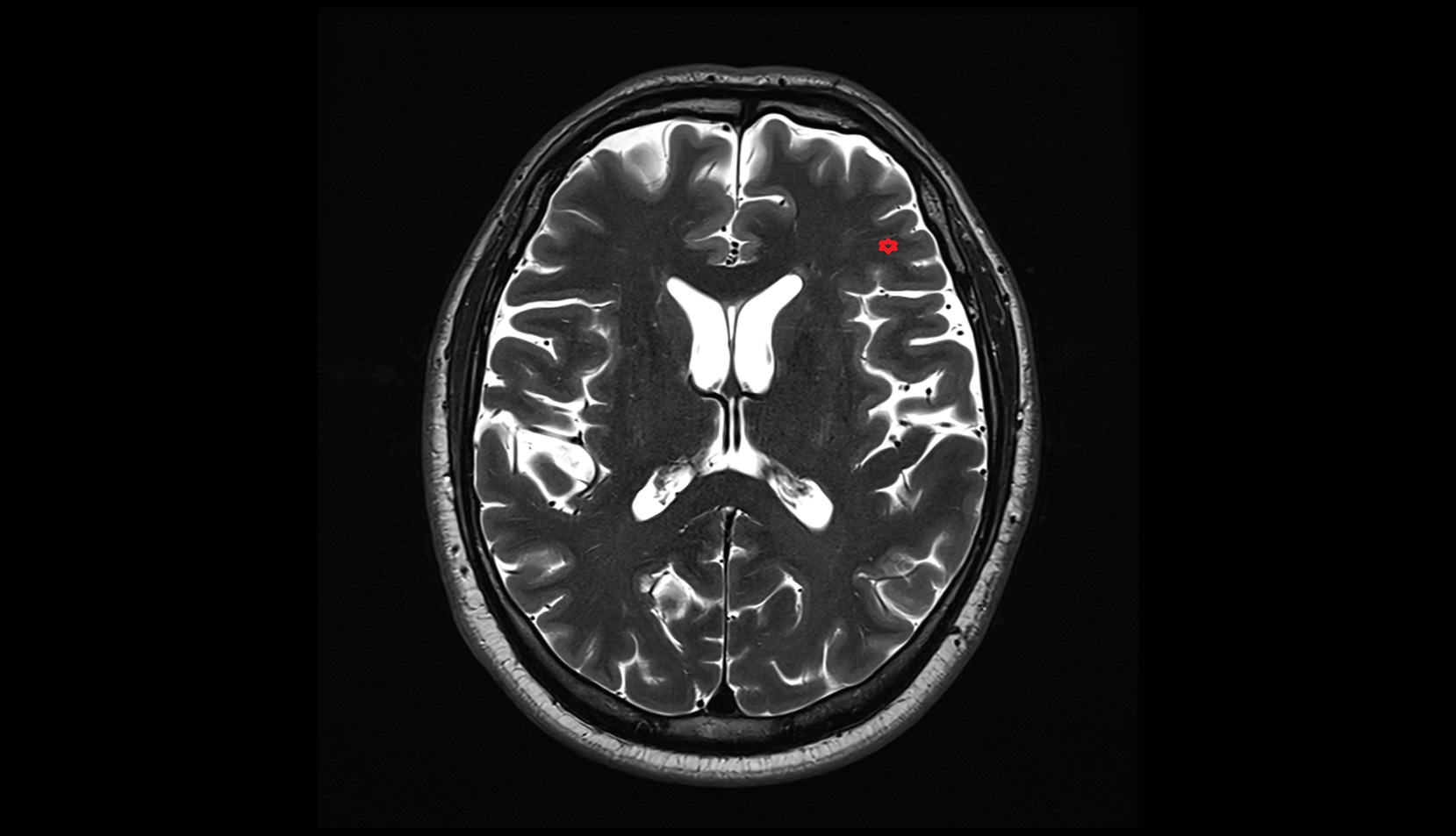 Inferior frontal gyrus MRI 3T axial IMAGE