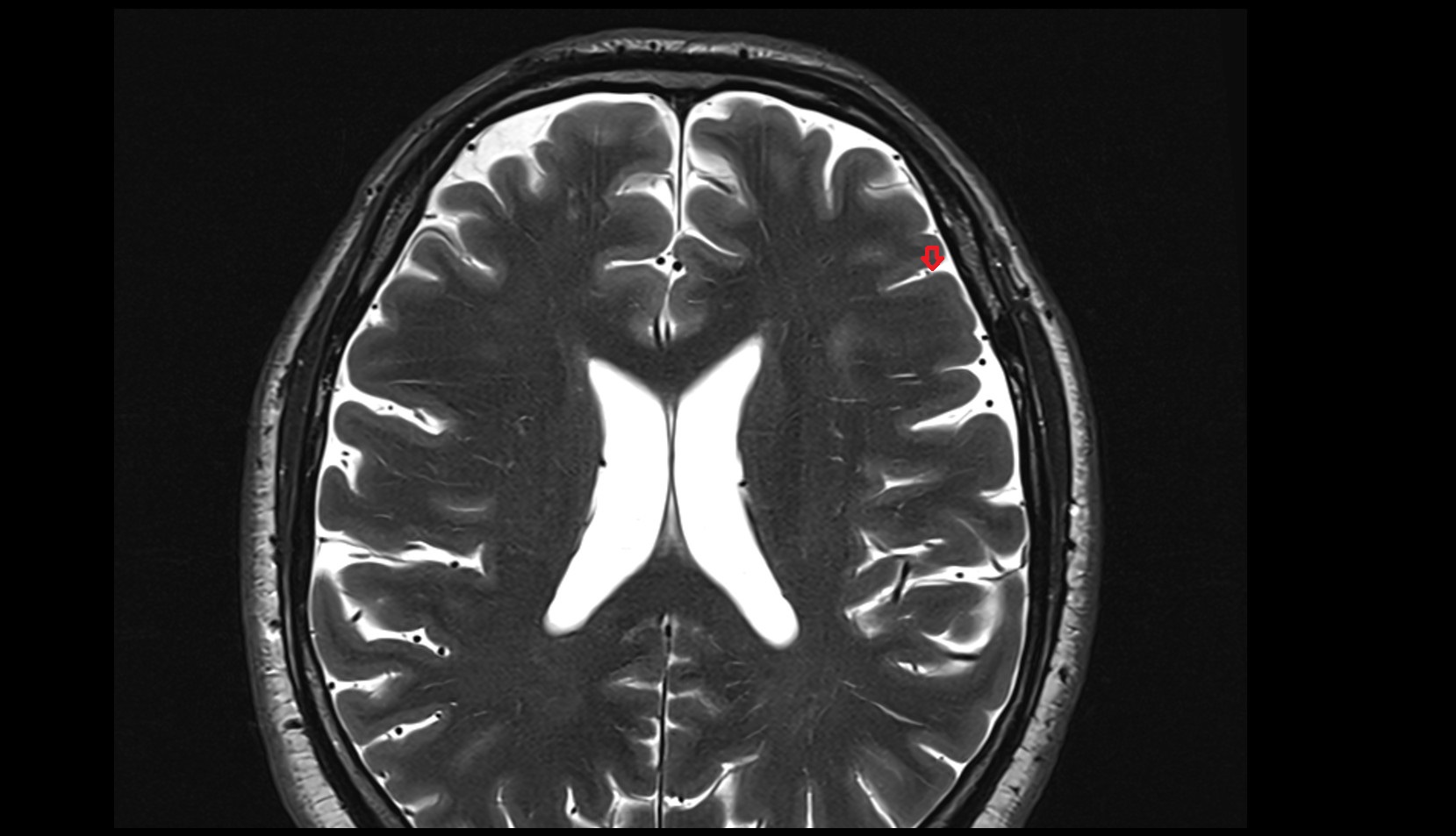 Inferior frontal sulcus MRI 3T axial image