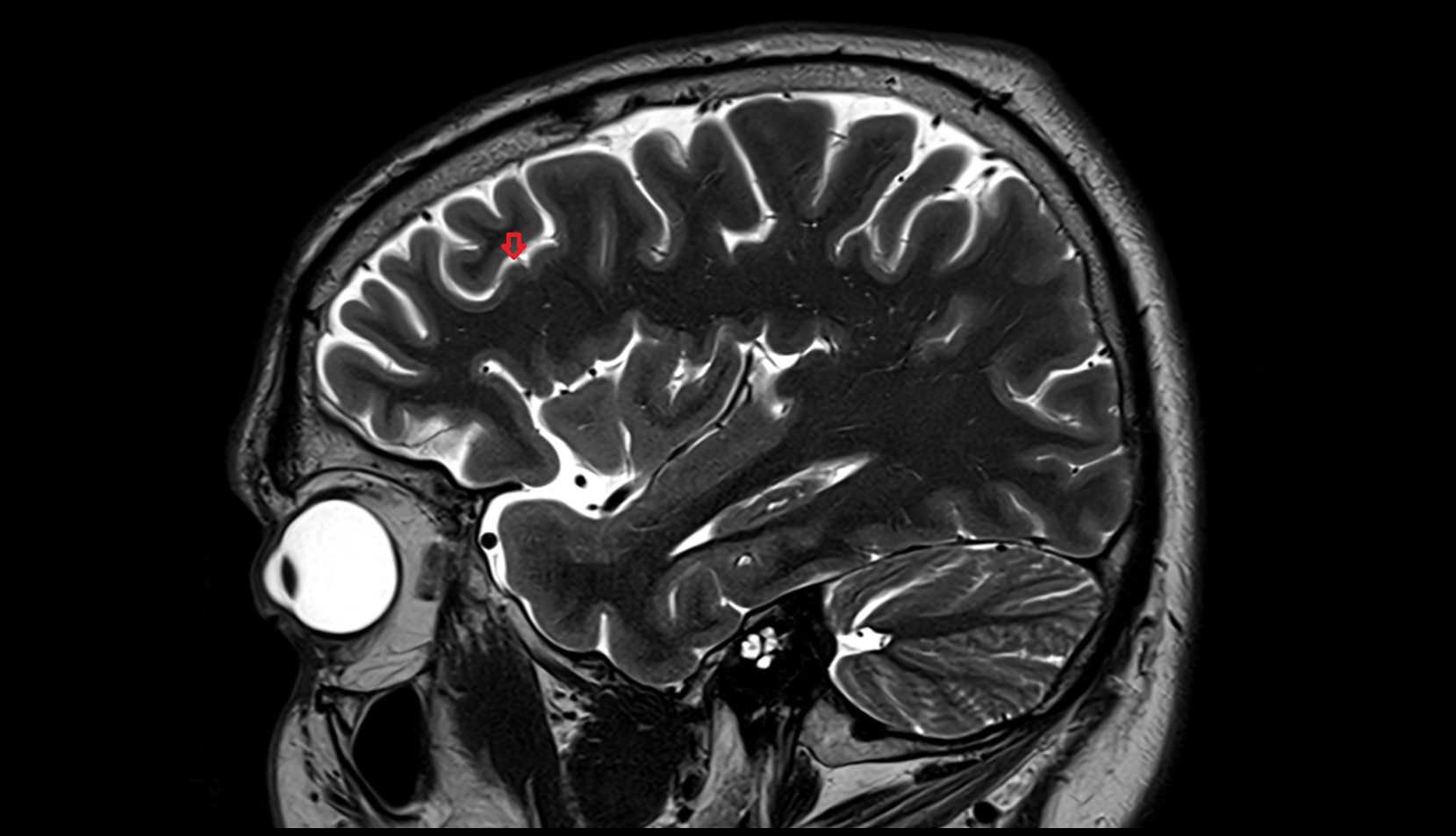 Inferior frontal sulcus MRI 3T sagittal image