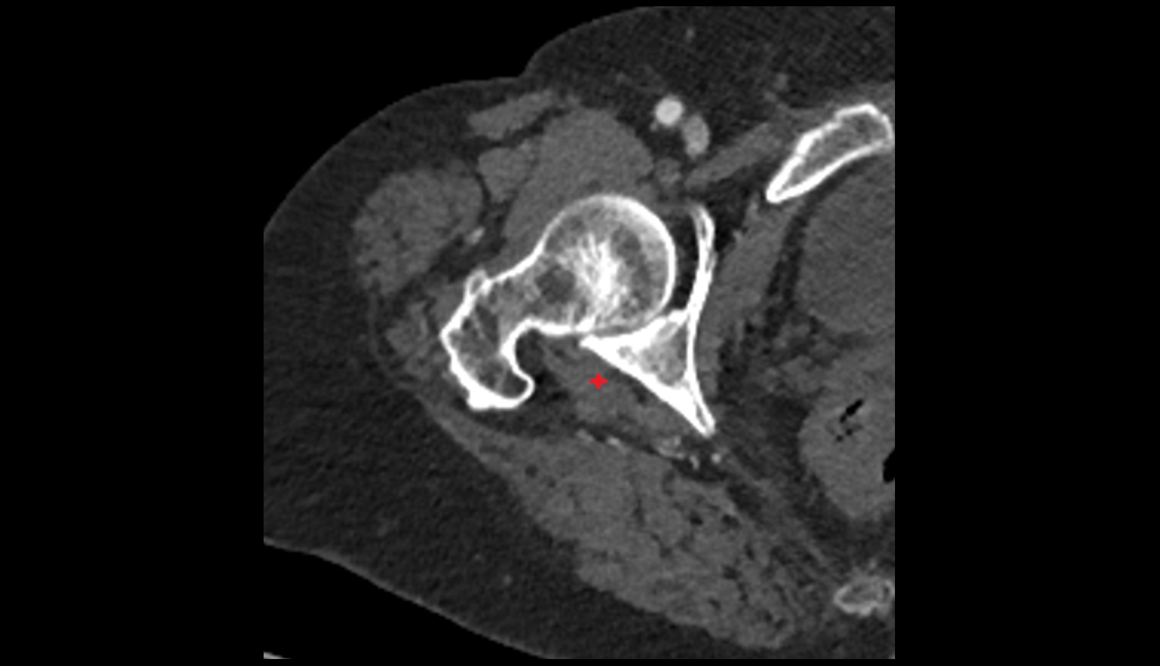 Inferior gemellus muscle CT axial image