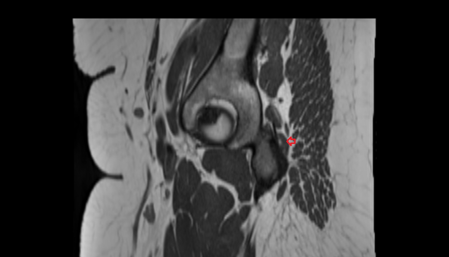 Inferior gemellus muscle MRI  SAG  anatomy image