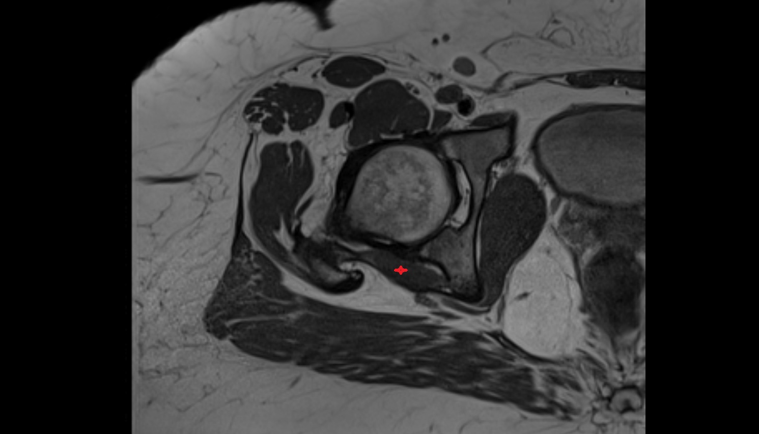 Inferior gemellus muscle   MRI  axial  anatomy  image-img-00000-00000